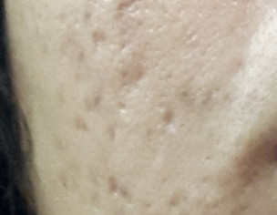Acne Scars And Marks