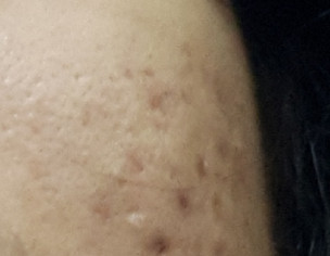 Acne Scars And Marks