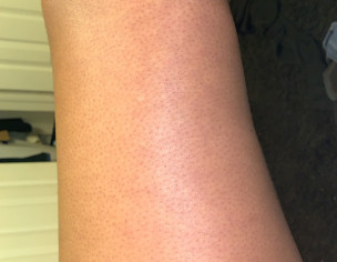 Skin Flare