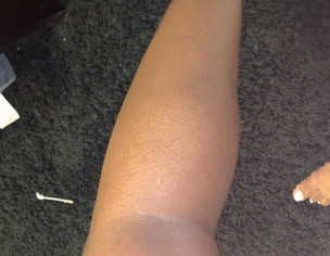 Skin Flare