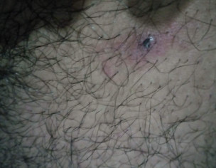 Bumps On My Penis And Balls 