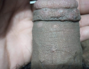Bumps On My Penis And Balls 
