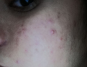 Face Skin Problem