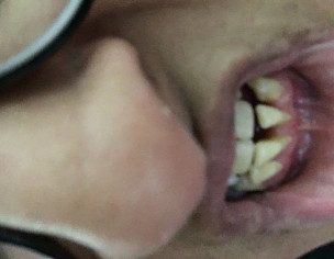 Teeth Decay