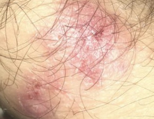Skin Rash On Hand 