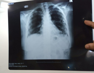 Continous Cough 