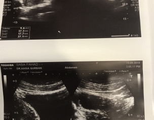 Ovarian Cysts