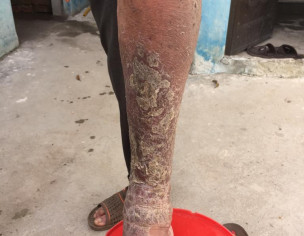 Left Leg Problem Due To DVT