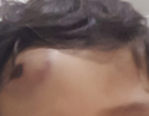 Forehead Hitting 