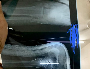 Accident, Fracture X Rays