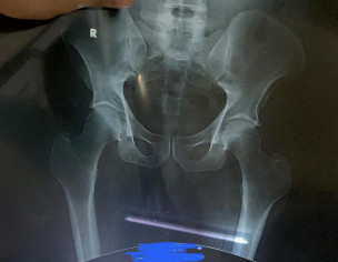 Accident, Fracture X Rays