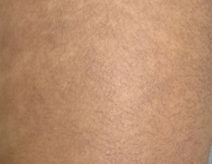 Skin Problem