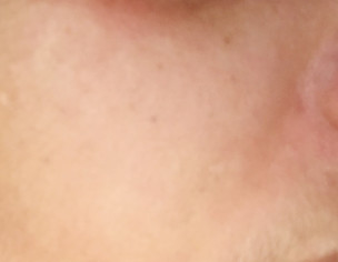Face Skin Issue
