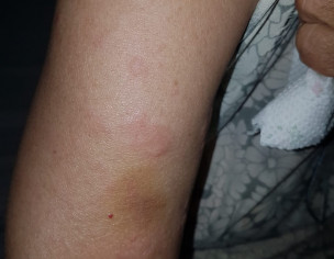 Skin Problem 