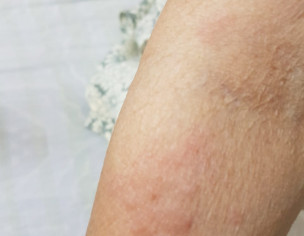 Skin Problem 