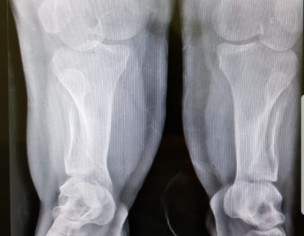 Bone Deformities 