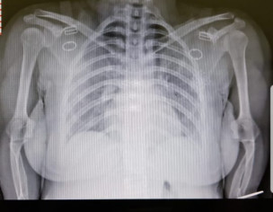 Bone Deformities 