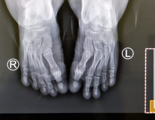 Bone Deformities 