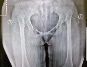 Bone Deformities 