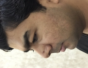 Pus Pimples On Face