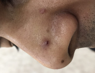 Pus Pimples On Face