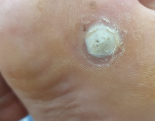 Foot Wart/corn