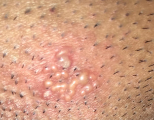 Skin Problem