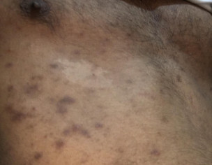 Skin Problem