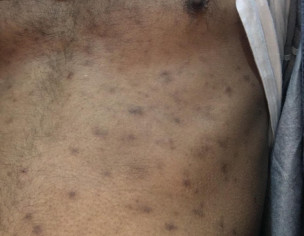 Skin Problem