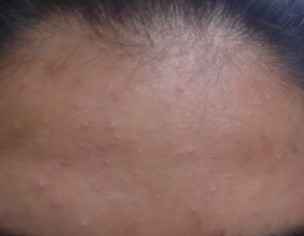 Pimples On Face
