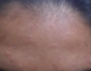 Pimples On Face