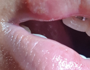 Pox On Lip