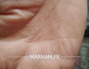 Skin Problem 