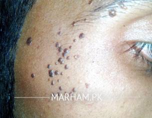 Skin Problem