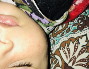 Acne At Cheeks 