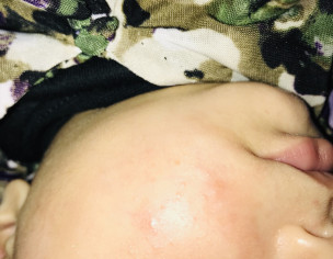 Acne At Cheeks 