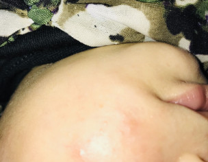 Acne At Cheeks 
