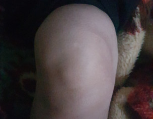 Knee Pain 