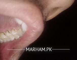 Teeth Problem