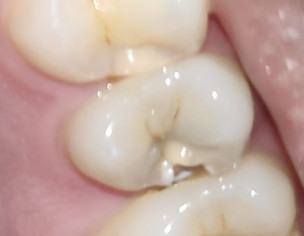 Broken Tooth