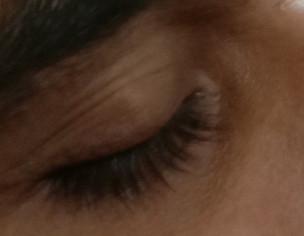 Upper Eyelid Guilty