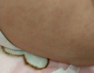 Rashes On Skin