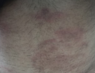 Skin Problem
