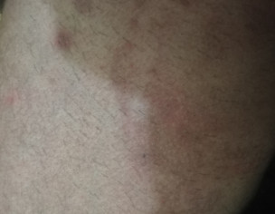 Skin Problem
