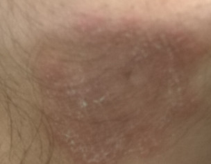 Skin Problem