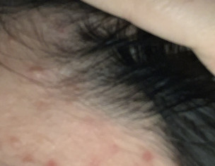 Acne Harmon