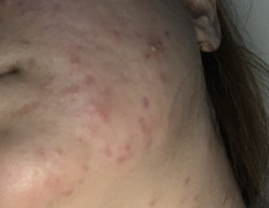 Acne Harmon