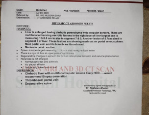 Liver Cancer