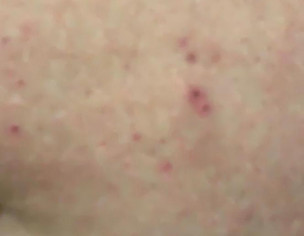 Itching On Stomach