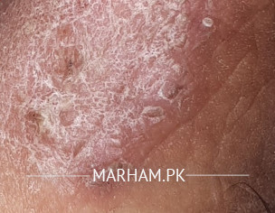Skin Problem